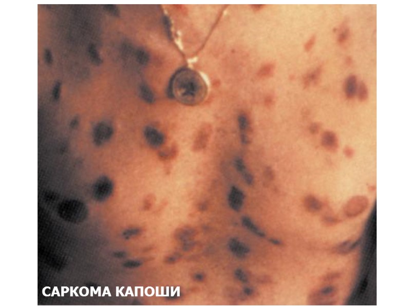 САРКОМА КАПОШИ